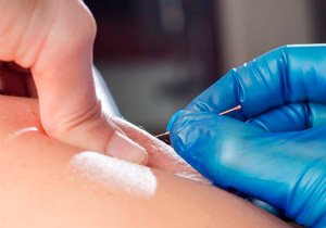 Formation Dry Needling - Prérequis